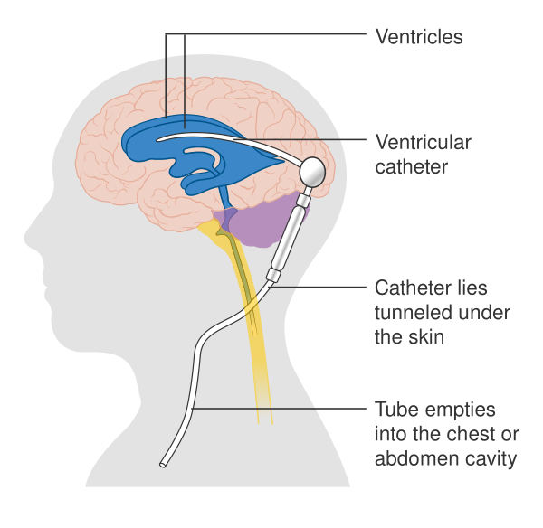 Diagram Showing A Brain Shunt CRUK 052
