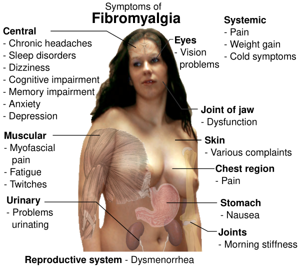 Fibromyalgia Symptoms