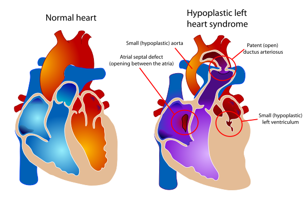 Hypoplastic Left Heart Syndrome