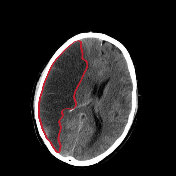 Infarction