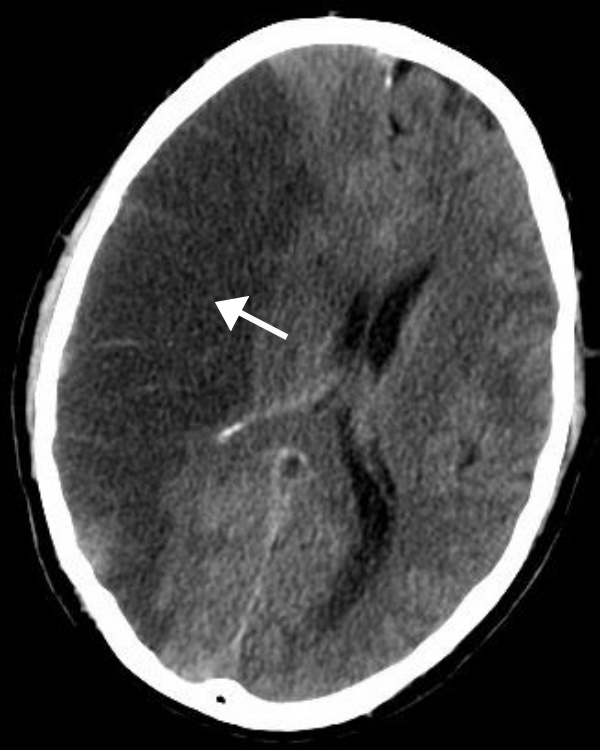 MCA Territory Infarct