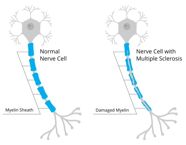 Myelin Sheath Damage In Multiple Sclerosis