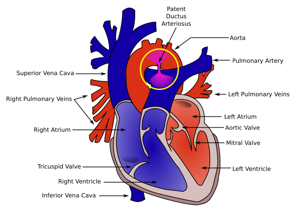 Patent Ductus Arteriosus
