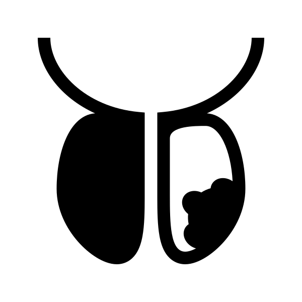 Prostate Cancer