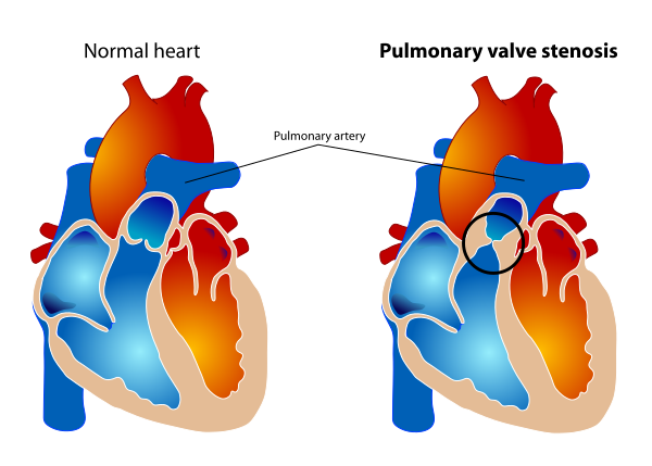 Pulmonary Valve Stenosis