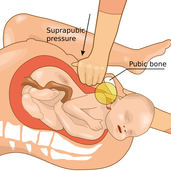 Shoulder Dystocia Hariadhi