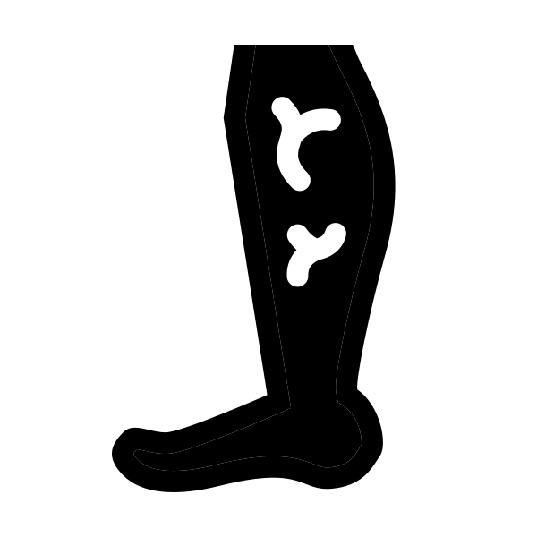 Varicose Vein